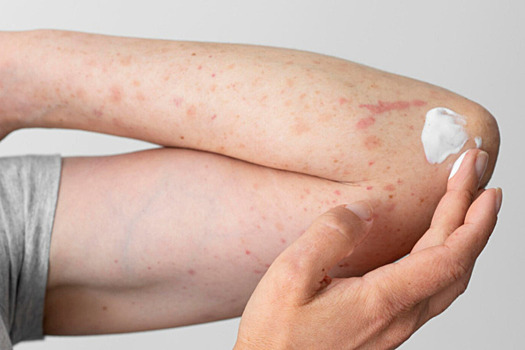 Названы хронические кожные заболевания, обостряющиеся осенью