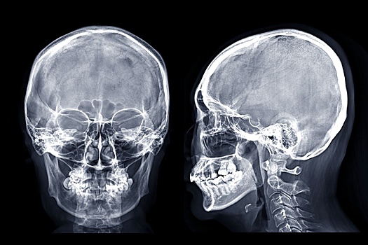 "Заплатка для мозга": Самарские медики изготовили уникальные импланты для восстановления костей черепа