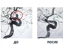 В Красногорской больнице появилась новая методика лечения аневризмы