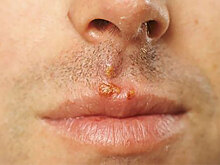 Врач предупредил влюблённых: с этой болезнью сталкивается каждый второй