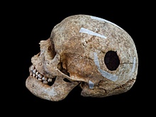 Череп «великана» со следами трепанации нашли в погребении эпохи викингов