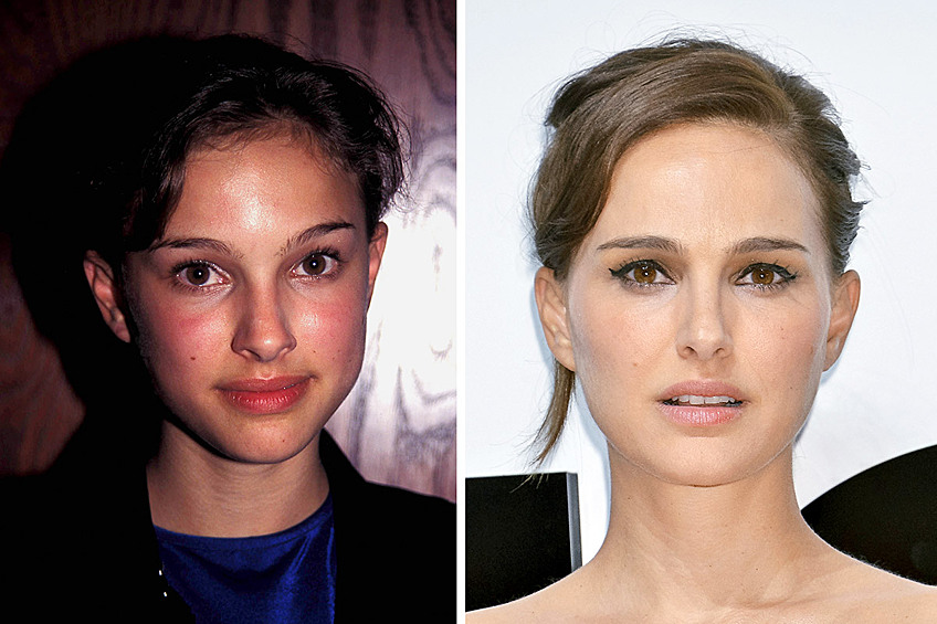 Натали Портман. Нетрудно заметить изменения, произошедшие с лицом звезды. "Родной" нос Натали был довольно крупным, кроме того была видна небольшая ассиметрия. В результате операции Портман стала обладательницей аккуратного, тонкого органа обоняния. На данный момент это единственная операция Натали по коррекции внешности.