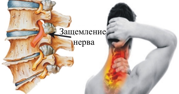 Как лечить защемление нерва — Рамблер/доктор