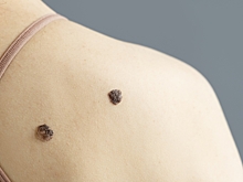 Какие народные средства помогут избавиться от бородавок у детей