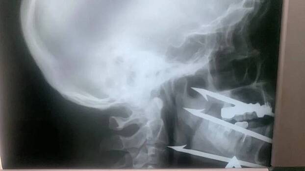 Волгоградские врачи спасли рыбака, ранившего себя гарпуном в лицо