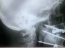 Волгоградские врачи спасли рыбака, ранившего себя гарпуном в лицо