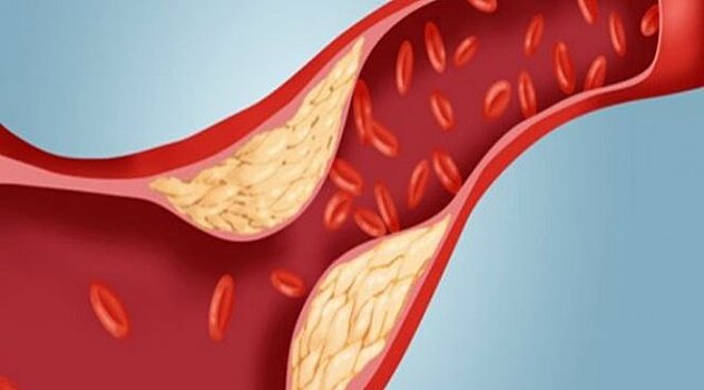 Врачи изменили свое мнение о «хорошем» холестерине