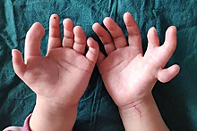 Девочке с 14 пальцами отрезали лишнее
