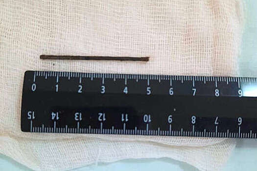 Mash: в Благовещенске врачи достали из мужчины мебельный гвоздь