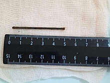 Mash: в Благовещенске врачи достали из мужчины мебельный гвоздь