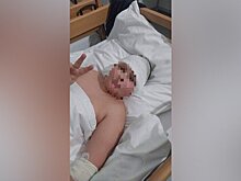 В Подмосковье завели дело после того, как мальчику проткнули щеку палкой