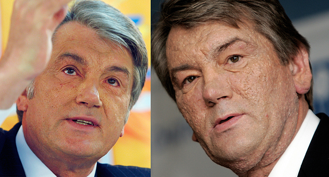 Бывший президент Украины Виктор Ющенко (после оперции и до)