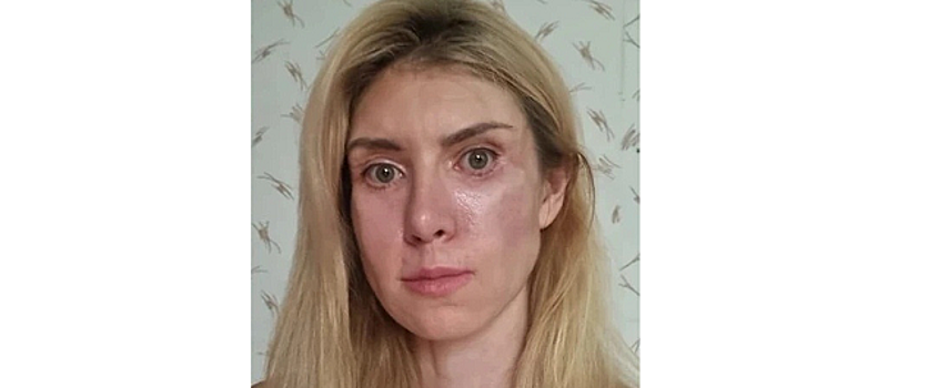Модель из Сочи отсудила у клиники красоты 3,5 млн рублей за неудачную пластическую операцию