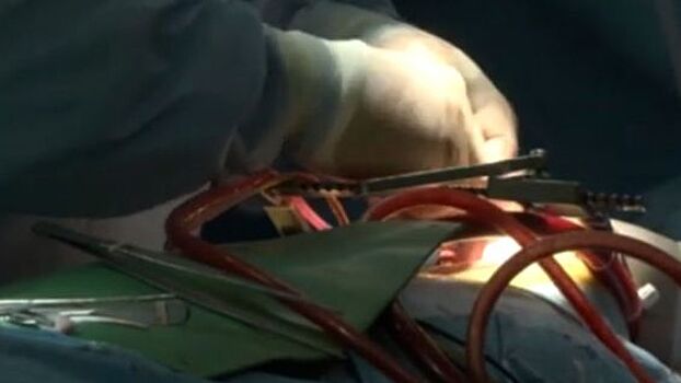 Уникальная операция: Сибирские кардиохирурги установили девушке два механических сердца