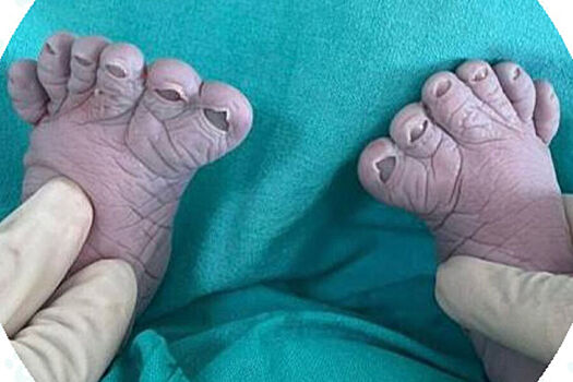 Россиянка родила ребенка с 12 пальцами на ногах