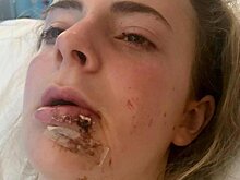 Получившей копытом по лицу девушке нужна новая челюсть