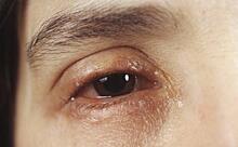 Россиянам перечислили неочевидные симптомы рака глаз