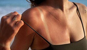 Правила ухода за кожей после солнечных ванн