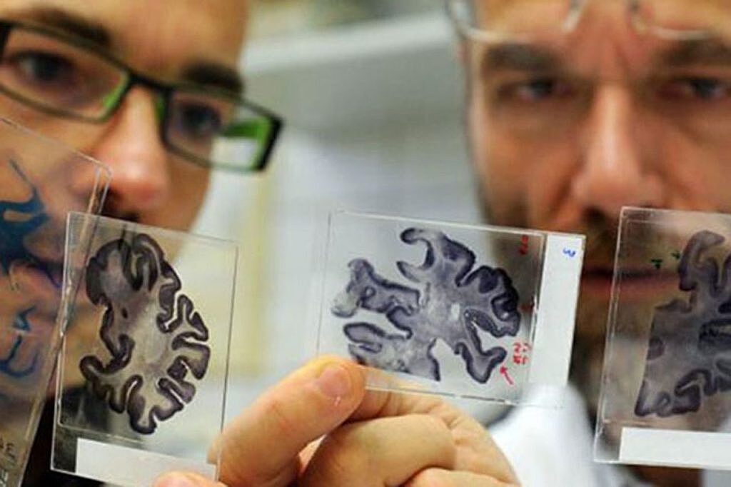 Ученые «взломали» болезнь Альцгеймера