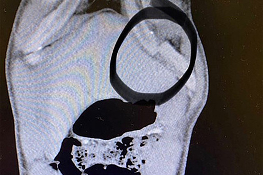 Снимок сломанного ребра экс-чемпиона UFC взорвал сеть