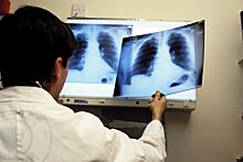 Большинству россиян с раком лёгких ставят диагноз на поздних стадиях