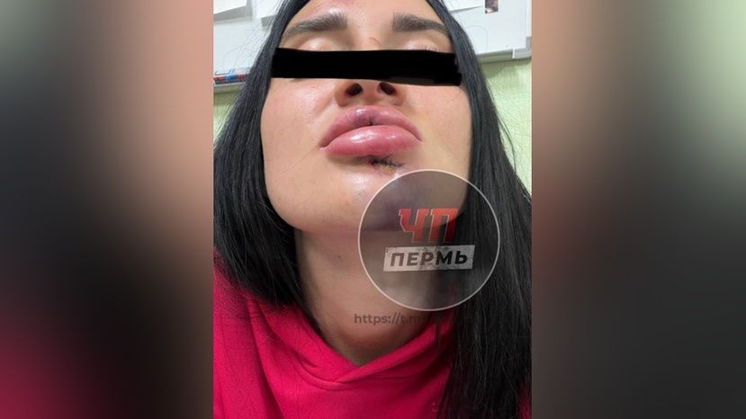 Неизвестный избил девушку в пермском клубе и сломал ей зубы