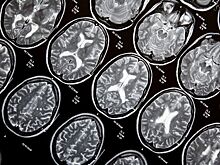 Антиоксиданты признали эффективным средством против склероза