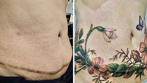 25 татуировок для перекрытия шрамов и других дефектов на теле