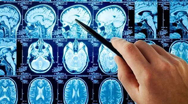 Неврологи: инсульт все чаще случается у молодых