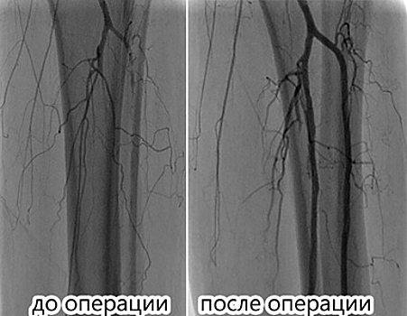 Рентгенохирурги ГКБ имени Вересаева в САО спасли от ампутации единственную ногу пациентки