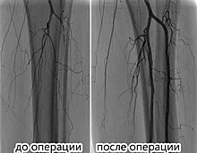 Рентгенохирурги ГКБ имени Вересаева в САО спасли от ампутации единственную ногу пациентки
