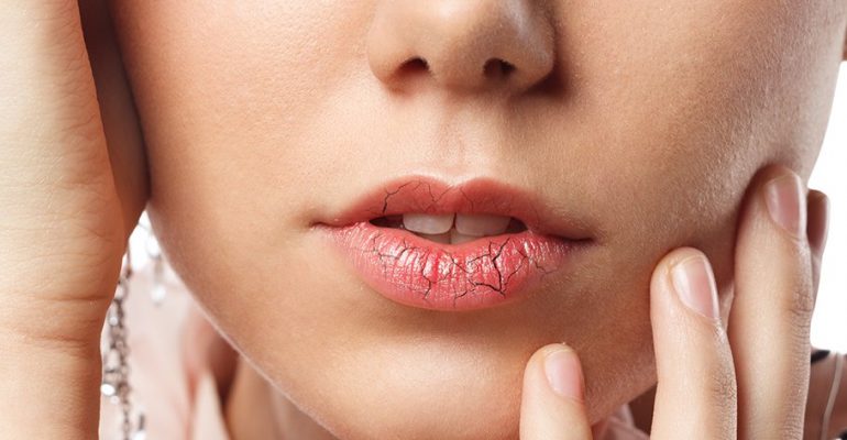 Обветренные губы: как быстро избавиться от шелушения и покраснения -  Рамблер/новости