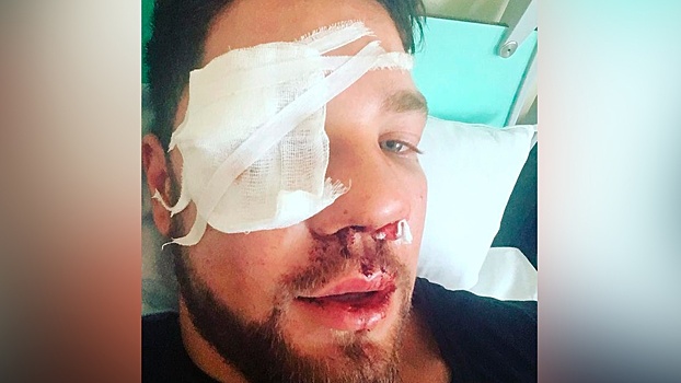 Переломы лицевой кости и носа: избитый в московском метро опубликовал фото из больницы