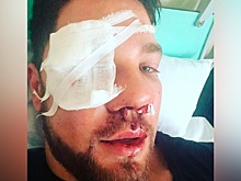 Переломы лицевой кости и носа: избитый в московском метро опубликовал фото из больницы