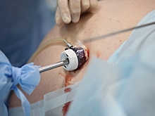 Уролог из Волгограда рассказал, как сейчас удаляют камни из почек