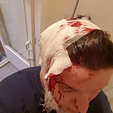Помощник депутат гордумы, «пострадавший от неизвестных», побил себя сам