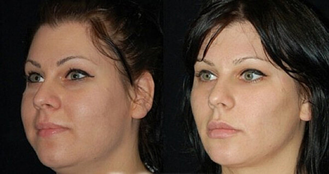 Никаких пухлых щек: как меняются лица женщин после удаления комков Биша