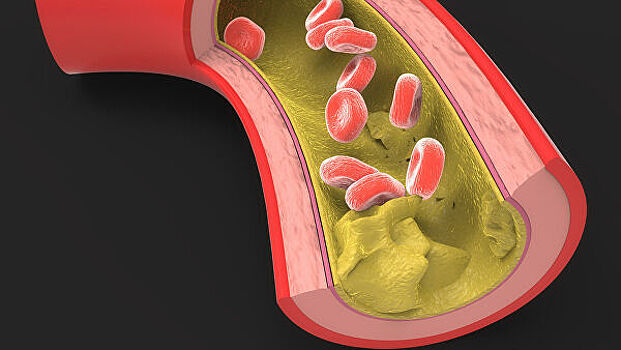 Врач рассказал, как снизить холестерин без лекарств