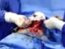 Мужчина в Индии проглотил более 600 гвоздей и не получил серьезных травм