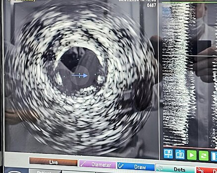 В Кировской областной клинической больнице впервые провели операцию на сосудах сердца с помощью ВСУЗИ