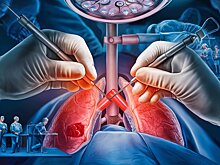 Ученые улучшили результаты хирургического лечения рака легкого