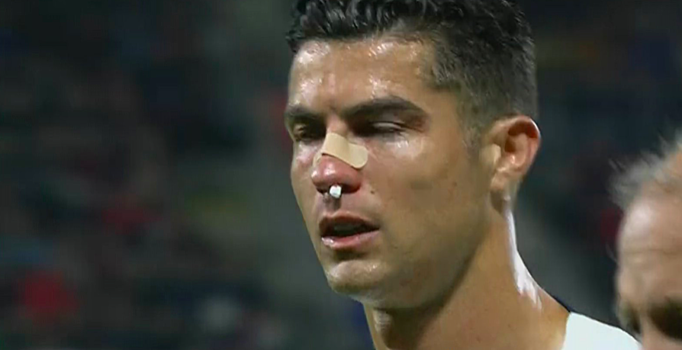 Из-за игры рукой Роналду в ворота Португалии назначили пенальти. Криштиану закрывал лицо в прыжке – он разбил нос ранее