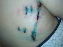 В Среднеуральске собака, сорвавшаяся с цепи, покусала мать двоих детей