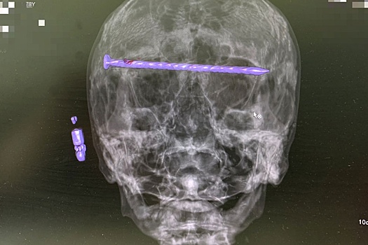 В Нижнем Тагиле спасли мужчину с 15-сантиметровым гвоздем в голове