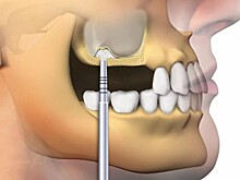 Разновидности синус-лифтинга: открытый и закрытый методы
