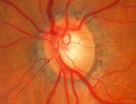 Ученые предложили новую методику лечения глаукомы