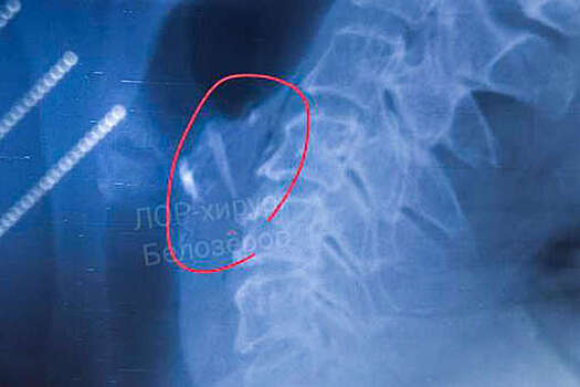 В Нижегородской области врачи спасли мужчину с застрявшей в горле костью