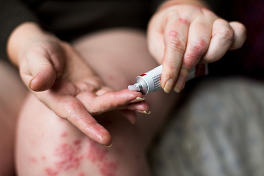 5 самых распространенных летних болезней кожи