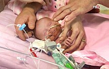 В Британии спасли девочку, родившуюся с сердцем вне грудной клетки