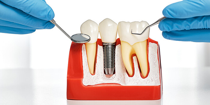 Стоматолог рассказал о реальном сроке службы зубных имплантов
